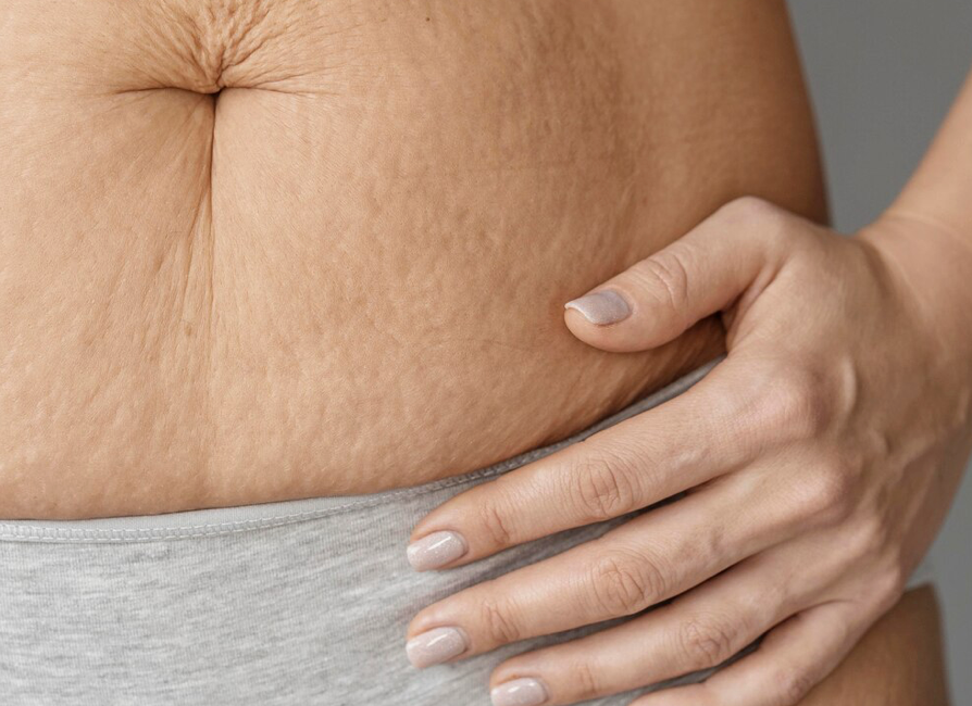 5 Effective Ways to Reduce Cellulite